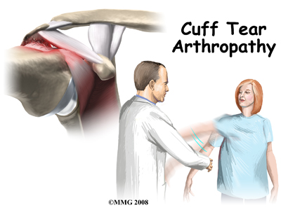 Rotator Cuff Tear Arthropathy