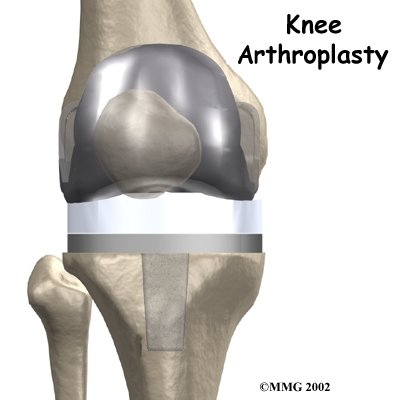 Artificial Joint Replacement of the Knee